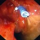 Endoscopic plastic biliary stent