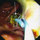 Plastic biliary stent in blocked metallic stent
