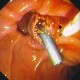 Needle knife papillotomy