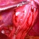 Laparoscopic resection of G.I. stromal tumour