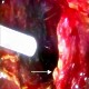 Talc pleurodesis for pleural metastases with effusion