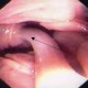 Ascaris entering common bile duct