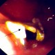 Denture in crico-pharyngeal oesophagus