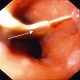 Fishbone in mid-oesophagus