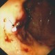 Hemoclip for bleeder in benign gastric ulcer