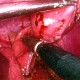 Laparoscopic resection of G.I. stromal tumour