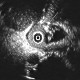 Intrahepatic ductal stones